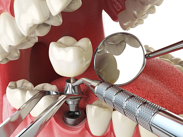 Best Chipped Tooth Repair Near Me  in Harlem Heights, FL
